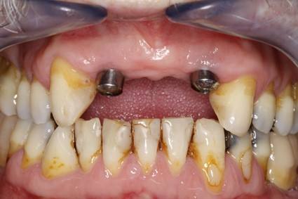 cirugia-bucal-e-implantologia-caso-1-foto-2