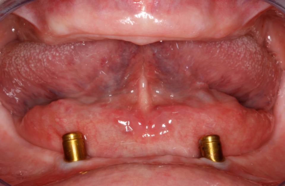 cirugia-bucal-e-implantologia-caso-5-foto-2