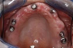 cirugia-bucal-e-implantologia-caso-6-foto-1