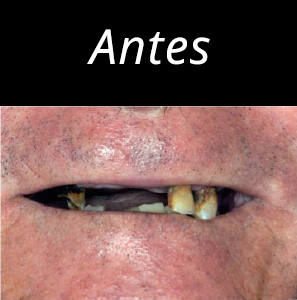 dientes-en-un-dia-foto-3