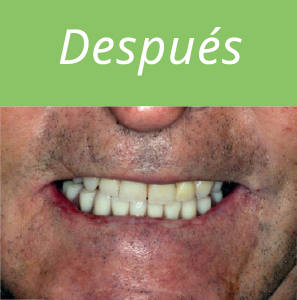 dientes-en-un-dia-foto-4