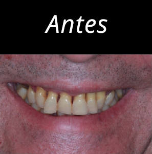 dientes-en-un-dia-foto-5