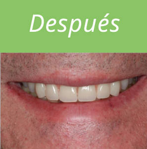 dientes-en-un-dia-foto-6