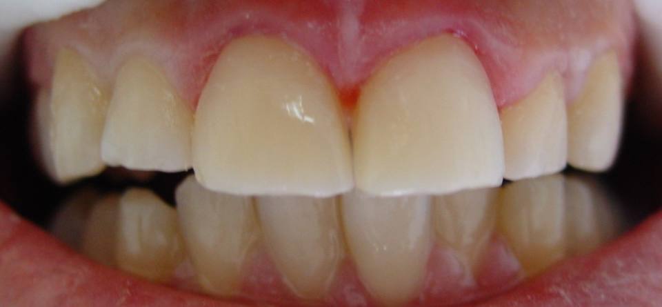 odontologia-conservadora-y-endodoncia-caso-1-foto-2