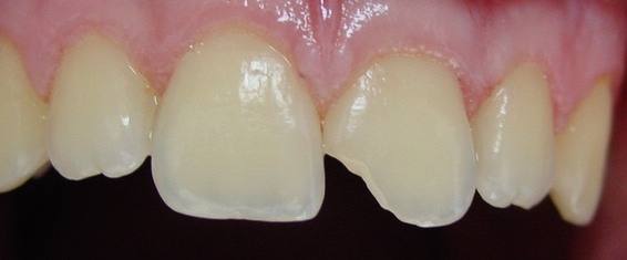 odontologia-conservadora-y-endodoncia-caso-2-foto-1