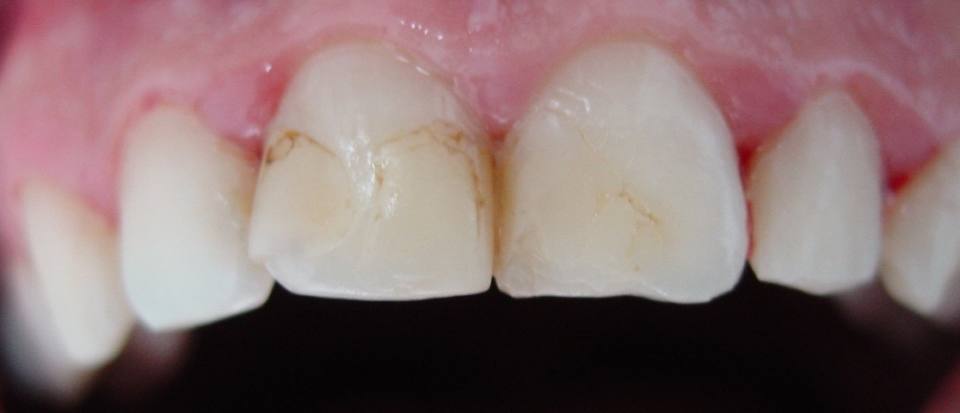 odontologia-conservadora-y-endodoncia-caso-3-foto-1