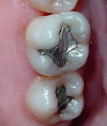 odontologia-conservadora-y-endodoncia-caso-4-foto-1