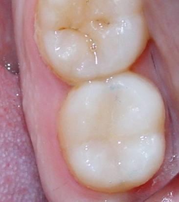 odontologia-conservadora-y-endodoncia-caso-4-foto-3