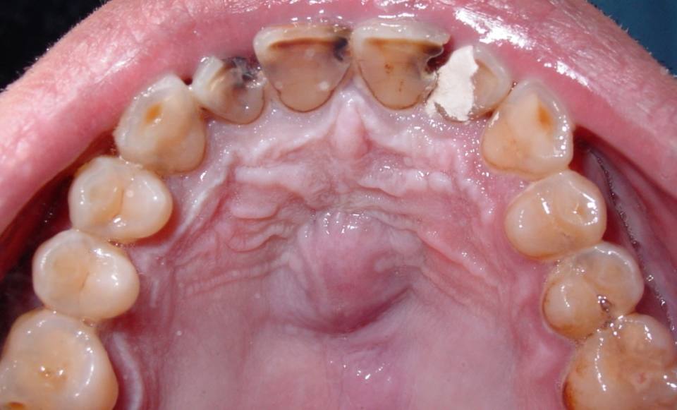 odontologia-conservadora-y-endodoncia-caso-5-foto-1