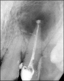 odontologia-conservadora-y-endodoncia-caso-5-foto-3