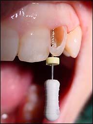 odontologia-conservadora-y-endodoncia-caso-5-foto-4