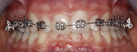 ortodoncia-y-odontopediatria-caso-2-foto-1
