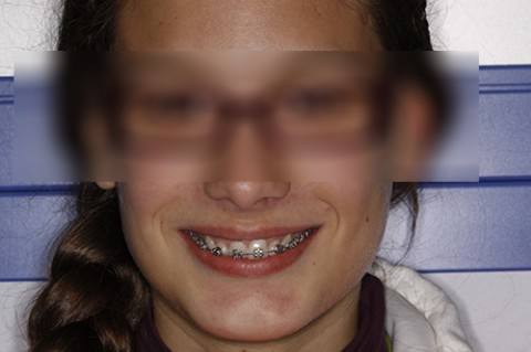 ortodoncia-y-odontopediatria-caso-2-foto-2