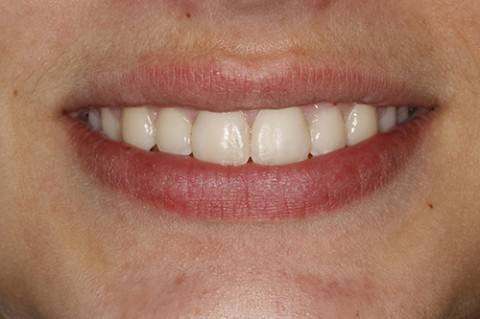 ortodoncia-y-odontopediatria-caso-2-foto-3
