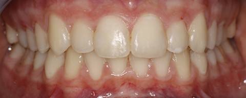 ortodoncia-y-odontopediatria-caso-2-foto-4