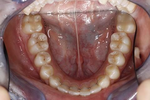 ortodoncia-y-odontopediatria-caso-2-foto-5