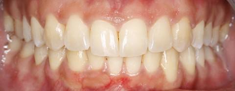 ortodoncia-y-odontopediatria-caso-3-foto-1