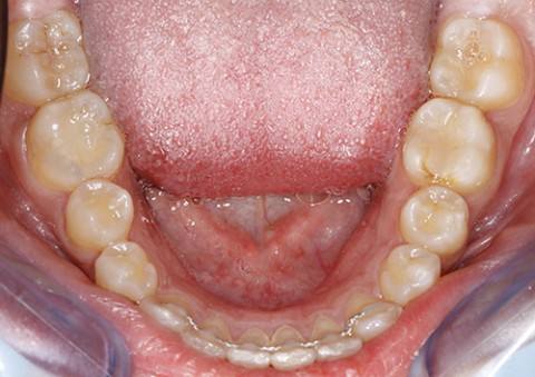 ortodoncia-y-odontopediatria-caso-3-foto-3