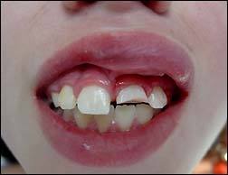 ortodoncia-y-odontopediatria-caso-4-foto-1