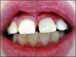 ortodoncia-y-odontopediatria-caso-4-foto-3