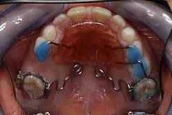 ortodoncia-y-odontopediatria-caso-5-foto-1