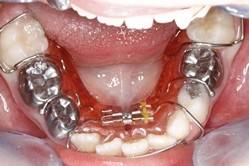 ortodoncia-y-odontopediatria-caso-6-foto-1