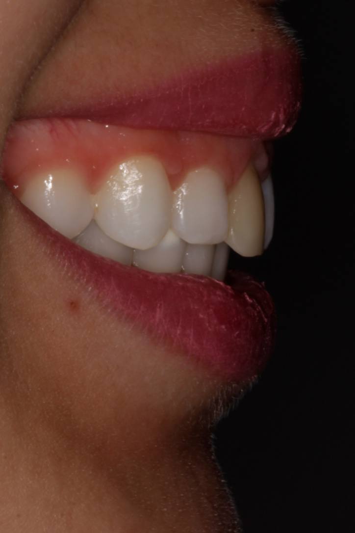 ortodoncia-y-odontopediatria-caso-7-foto-5