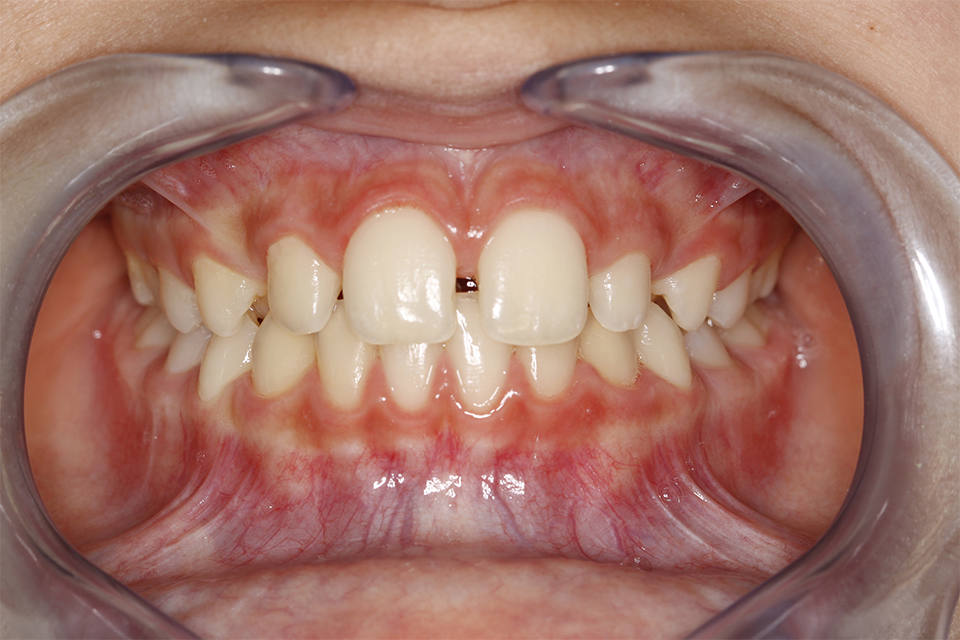 ortodoncia-y-odontopediatria-caso-9-foto-1