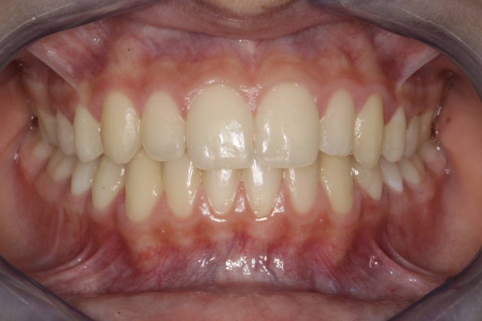 ortodoncia-y-odontopediatria-caso-9-foto-5