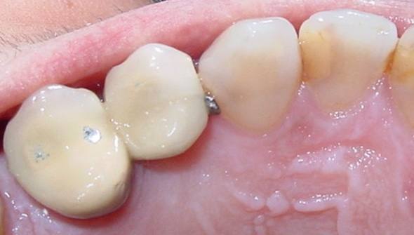 protesis-caso-2-foto-1