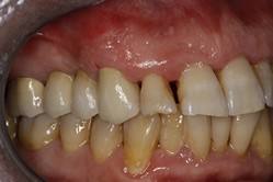 protesis-caso-5-foto-2